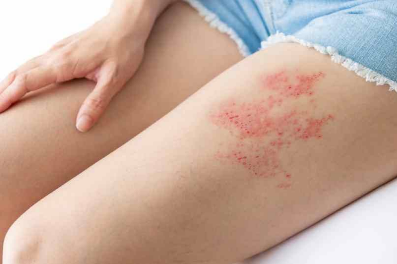 Shingles - Everything you need to know about it